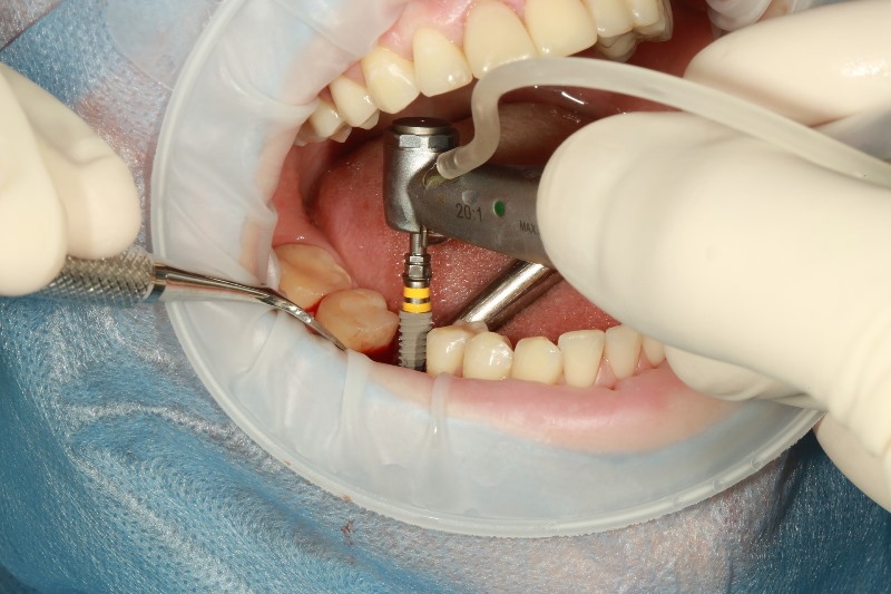 implant_dentar_vodita